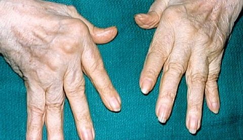 Боль в суставах пальцев рук